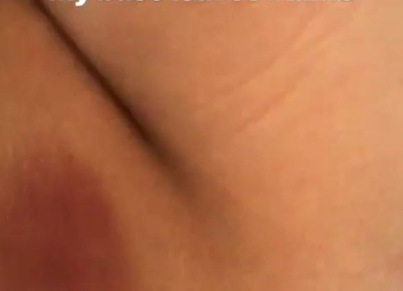 Bella Thorne showing her bruised naked ass on social media